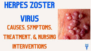 Image result for herpes zoster