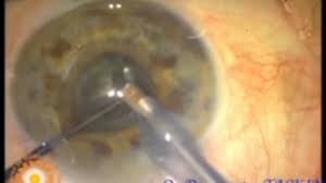 Pseudoexfoliation Cataract Surgery Fako Iol Adana Maya Goz