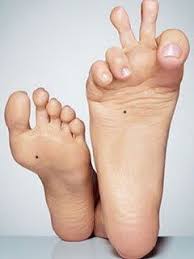 Image result for Mole on feet