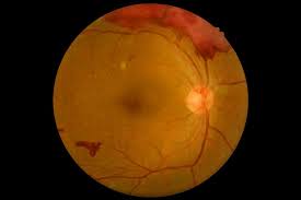 Ekolgoz Diyabetik Retinopati Tedavisi