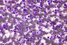 Fragkandrea i, nixon ja, panagopoulou p. Diffuse Large B Cell Lymphoma Wikipedia