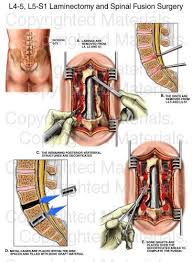 Nucleus Medical Media Spinal Fusion Surgery Spinal Fusion Spinal Surgery