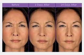 Botox Cosmetic Summit Plastic Surgery Wilmington Nc