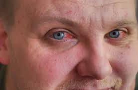 Then, wring out the washcloth and place the cloth over your face. How To Get Rid Of Bloodshot Eyes