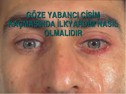Vucuda Yabanci Cisim Kacmasi Goze Yabanci Cisim Kacmasinda Ilkyardim Nasil Olmalidir