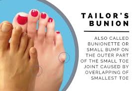 Overlapping Toes Symptoms And Treatment Ignoring Foot Conditions Like Overlapping Toes Can Lead To More Foot Bunion Treatment Tailors Bunion Bunion Remedies