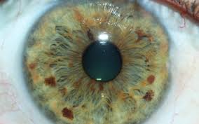rayid iris iridology birth order spiritual evolution