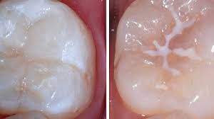 Sealants are also commonly known as silicone or mastic. What Is A Dental Fissure Sealant Banyo Dental
