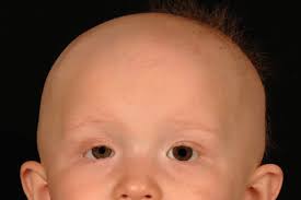 Unilateral Alopecia In Association With Horner S Syndrome Archives Of Disease In Childhood