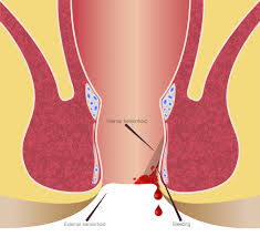 Image result for Hemorrhoid