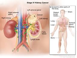 Likewise, the liver signals stress by discomforting pain. Renal Cell Cancer Treatment Pdq Health Professional Version National Cancer Institute