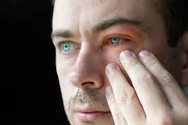 Image result for Allergic Conjunctivitis