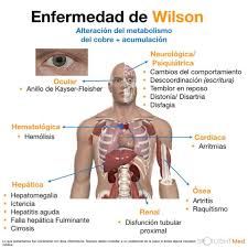 Existe mais de uma maneira de classificar as 500 doenas metablicas. Spotlightmed Enfermedad De Wilson Spotlightmedicine Facebook