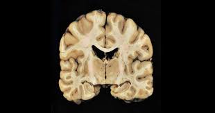 It has also been found in athletes who did not play sports. Scientists Zero In On Genetic Risk Factor For Alzheimer S Like Brain Disease Cte Cbs News