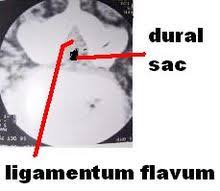 Failed Back Syndrome Wikipedia