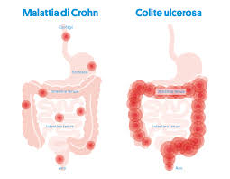 Con il termine colite o colite spastica si intende una generica infiammazione del colon, cioè il secondo tratto dell'intestino crasso. Malattia Infiammatoria Cronica Intestinale Mici La Mia Vita Con Mici