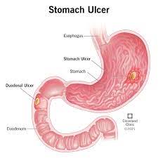 Stomach (Peptic) Ulcer: Signs, Symptoms, Causes & Treatment