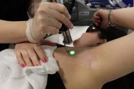 Laser hair removal in bedford on superpages.com. Best Laser Hair Removal Salon In Birmingham Top Laser Salon