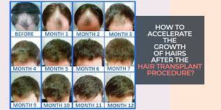 This is the typical length of the anagen phase, after which the hair will go through the other two stages (catagen and telogen). How To Accelerate The Growth Of Hairs After The Hair Transplant Procedure
