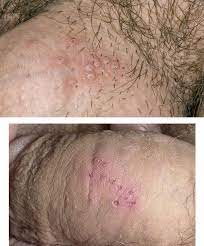 Maybe you would like to learn more about one of these? Ø§Ù„Ù‡Ø±Ø¨Ø³ Ø§Ù„ØªÙ†Ø§Ø³Ù„ÙŠ Ù…Ø§ Ù‡Ùˆ Ù†ÙˆØ¹ Ø§Ù„Ø£Ø¹Ø±Ø§Ø¶ ÙˆÙƒÙŠÙÙŠØ© Ø§Ù„ØªØ¹Ø§Ù…Ù„ Ù…Ø¹Ù‡Ø§ Ø·Ø±Ù‚ Ø§Ù„Ø¥ØµØ§Ø¨Ø© Ø¨Ø§Ù„Ù‡Ø±Ø¨Ø³ Ø§Ù„ØªÙ†Ø§Ø³Ù„ÙŠ Ø§Ù„Ø£Ø¹Ø±Ø§Ø¶ ÙˆØ§Ù„ØªØ´Ø®ÙŠØµ ÙˆØ§Ù„Ø¹Ù„Ø§Ø¬ ÙˆØ§Ù„ÙˆÙ‚Ø§ÙŠØ©