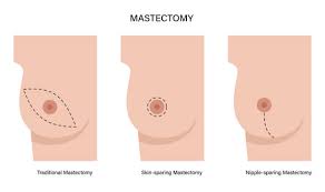 Image result for Mastectomy