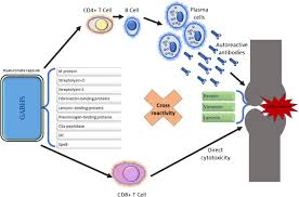 Image result for Poststreptococcal Reactive Arthritis