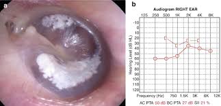 Image result for Myringosclerosis