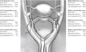 Bleeding after menopause or between. Pelvic Sentinel Lymph Node Detection In High Risk Endometrial Cancer Shrec Trial The Final Step Towards A Paradigm Shift In Surgical Staging Sciencedirect