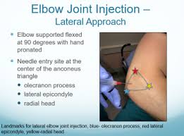 Image result for Elbow Joint Injection