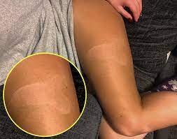 Woman's fake tan fail leaves giant penis-shaped mark on her leg | The Sun