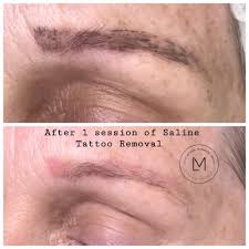 Does hydrogen peroxide fade tattoos? Saline Removal Lacey Michael Pmu