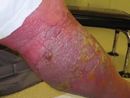 Image result for erysipel photos)