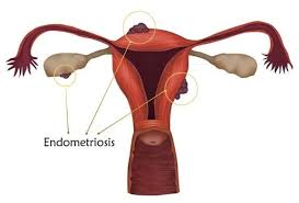 No entanto, para diagnosticar a endometriose, o médico examina a cavidade abdominal com um tubo fino de visualização (denominado laparoscópio) para conseguir ver diretamente se há tecido endometrial presente. Endometriose Gezondheid En Wetenschap