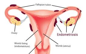 An overview of cochrane reviews. Endometriosis Gynoveda