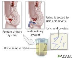 Relationship between serum uric acid levels with chronic kidney disease in a southeast asian 38. Uric Acid Urine Test Information Mount Sinai New York