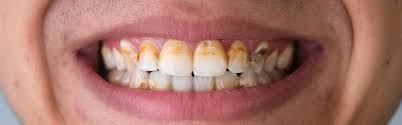 Check spelling or type a new query. Perbedaan Plak Dan Karang Gigi Yang Perlu Anda Ketahui Pepsodent