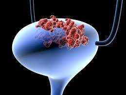 People with bladder cancer can sometimes have other tumors in these areas. Bladder Cancer Your Personal Risk And How To Reduce It Health Essentials From Cleveland Clinic