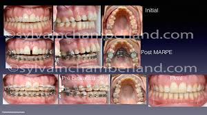 Vous avez moins de 30 ans ? Solutions Aux Dents Qui Se Chevauchent Dr Sylvain Chamberland