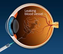 Avastin is used to suppress leaking abnormal blood vessels in the retina. Avastin Injection In Iran Razi Eye Clinic In Tehran Irantreatments