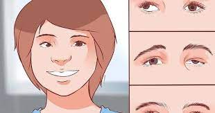 How To Get Rid Of A Lazy Eye With Pictures In 2021 Lazy Eye Exercises Eye Exercises Eyes