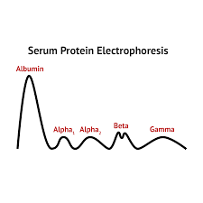 Multiple myeloma diagnosis test principle. Serum Protein Electrophoresis Serum Myeloma Multiple Myeloma