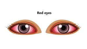 Bloodshot eyes appear red and irritated. Red Eyes Causes Symptoms Diagnosis And Treatment