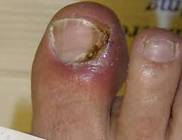 Image result for Onycholysis feet
