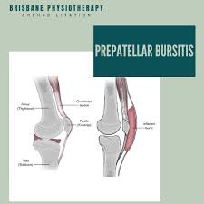 Image result for Prepatellar Bursitis