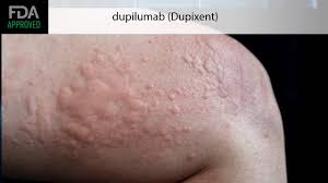 Image result for Hives