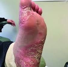 Image result for pompholyx soles of feet