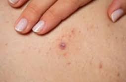 A lot of times, pus will form and it can be very irritating. How To Tell Genital Herpes Apart From Other Skin Conditions