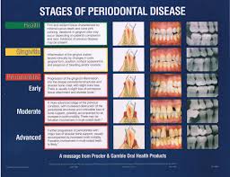 Stages Of Periodontal Disease Dentistry Dental Hygiene