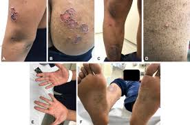 Syphilis can be successfully healed by antibiotic therapy. A Pemphigus Like Presentation Of Secondary Syphilis Jaad Case Reports