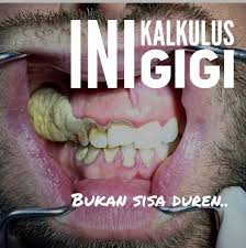 Menghilangkan karang gigi memang agak sulit, apalagi karang gigi yang membandel dan karena adanya beberapa faktor yang mempengaruhi karang karang gigi juga dapat dibersihkan, apalagi dengan menggunakan cara alami yang sehat yang aman bagi kesehatan mulut dan gigi pastinya. Agam Ferry Erwana Twitterren Kalkulus Gigi Merupakan Sisa Makanan Yg Menempel Pada Plak Gigi Dan Mengeras Sesuatu Yang Keras Gak Bisa Dibersihkan Dengan Yang Lembut Jadi Kalo Ada Produsen Obat Kumur Yg